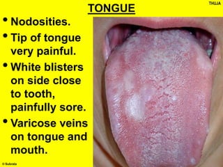 © Subrata
TONGUE
•Nodosities.
•Tip of tongue
very painful.
•White blisters
on side close
to tooth,
painfully sore.
•Varicose veins
on tongue and
mouth.
THUJA
 