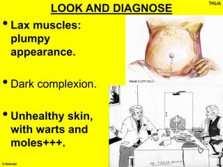 © Subrata
LOOK AND DIAGNOSE
•Lax muscles:
plumpy
appearance.
•Dark complexion.
•Unhealthy skin,
with warts and
moles+++.
THUJA
 