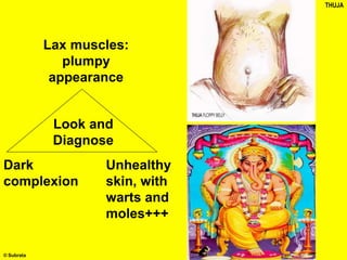 Lax muscles:
plumpy
appearance
Dark
complexion
Unhealthy
skin, with
warts and
moles+++
THUJA
Look and
Diagnose
© Subrata
 