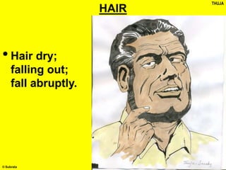 © Subrata
HAIR
•Hair dry;
falling out;
fall abruptly.
THUJA
 