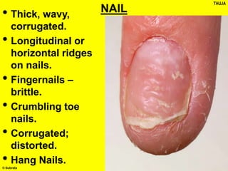 © Subrata
NAIL
• Thick, wavy,
corrugated.
• Longitudinal or
horizontal ridges
on nails.
• Fingernails –
brittle.
• Crumbling toe
nails.
• Corrugated;
distorted.
• Hang Nails.
THUJA
 