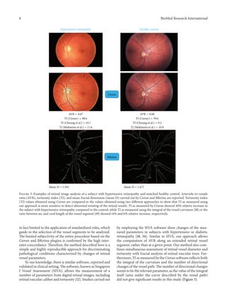 8 BioMed Research International
Hypertensive retinopathy Healthy control
Mean -D = 1.391MeaMMMMMMMMMMMMMMMM n -D =============== 1.391393939139139391993939393
AVR = 0.67
TI (Cioran) = 98.6
TI (Cheung et al.) = 10.7
TI (Mohsenin et al.) = 11.6
AVR = 0.88
TI (Cioran) = 59.6
TI (Cheung et al.) = 9.2
TI (Mohsenin et al.) = 10.9
Mean-D = 1.471Mean-D = 1.391
BRetina
Cioran
Figure 3: Examples of retinal image analysis of a subject with hypertensive retinopathy and matched healthy control. Arteriole-to-venule
ratio (AVR), tortuosity index (TI), and mean fractal dimension (mean-D) carried out by Cioran and BRetina are reported. Tortuosity index
(TI) values obtained using Cioran are compared to the values obtained using two different approaches to show that TI as measured using
our approach is more sensitive to detect abnormal twisting of the retinal vessels. TI as measured by Cioran showed 40% relative increase in
the subject with hypertensive retinopathy compared to the control, while TI as measured using the integral of the vessel curvature [18] or the
ratio between arc and cord length of the vessel segment [19] showed 14% and 6% relative increase, respectively.
in fact limited to the application of standardized rules, which
guide in the selection of the vessel segments to be analyzed.
The limited subjectivity of the entire procedure based on the
Cioran and BRetina plugins is confirmed by the high inter-
rater concordance. Therefore, the method described here is a
simple and highly reproducible approach for discriminating
pathological conditions characterized by changes of retinal
vessel parameters.
To our knowledge, there is similar software, reported and
validated in clinical setting. The software, known as Singapore
I Vessel Assessment (SIVA), allows the measurement of a
number of parameters from digital retinal images, including
retinal vascular caliber and tortuosity [12]. Studies carried out
by employing the SIVA software show changes of the mea-
sured parameters in subjects with hypertensive or diabetic
retinopathy [18, 34]. Similar to SIVA, our approach allows
the computation of AVR along an extended retinal vessel
segment, rather than at a given point. Our method also com-
bines simultaneous assessment of retinal vessel diameter and
tortuosity with fractal analysis of retinal vascular trees. Fur-
thermore, TI as measured by the Cioran software reflects both
the integral of the curvature and the number of directional
changes of the vessel path. The number of directional changes
seems to be the relevant parameter, as the value of the integral
itself (area under the curve described by the vessel path)
did not give significant results in this study (Figure 3).
 