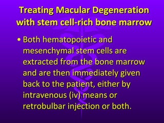 Treating Macular Degeneration with stem cell-rich bone marrow Both hematopoietic and mesenchymal stem cells are extracted from the bone marrow and are then immediately given back to the patient, either by intravenous (iv) means or retrobulbar injection or both.  