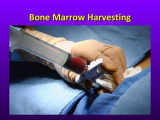 Bone Marrow Harvesting 