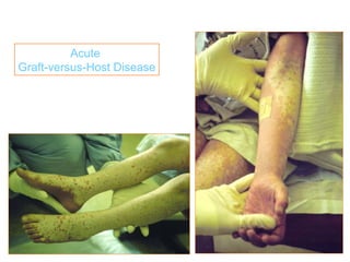 Acute
Graft-versus-Host Disease
 