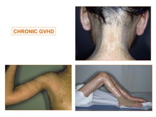 CHRONIC GVHD
 