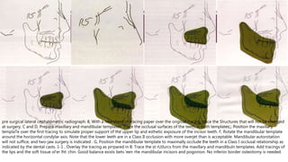 pre surgical lateral cephalometric radiograph. 8, With a new sheet of tracing paper over the origioal rracing, trace the Slructures that will not be changed
at surgery. C and D, Prepare maxillary and mandibular templates. Trace the occlusal surfaces of the teeth in both templates;;, Position the maxillary
templaTe over the first tracing to simulate proper support of the upper lip and esthetic exposure of the incisor teeth. F, Rotate the mandibular template
around the horizontal condylar axis. Note that the lower leeth are in a Class II occlusion with more overjet than is acceptable. Mandibular autorotation
will not suffice, and two-jaw surgery is indicated . G, Position the mandibular template to maximally occlude Ihe teeth in a Class I occlusal relationship as
indicated by the dental casts. 1-1 , Overlay the tracing as prrpared in B. Trace the st rU(lurcs from the maxillary and mandibuln templates. Add tracings of
the lips and the soft tissue ol'er lht: chin. Good balance exists betv.'een rhe mandibular incisors and pogonion. No inferior border osteotomy is needed.
 