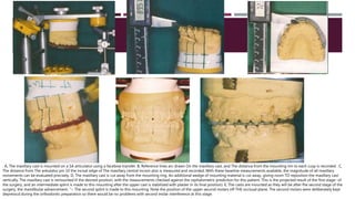 . A, The maxillary cast is mounted on a SA articulator using a facebow transfer. B, Reference lines arc drawn On the maxillary cast, and The distance from the mounting rim to each cusp is recorded . C,
The distance from The ankulator pin 10 the incisal edge of The maxillary central incisor also is measured and recorded. With these baseline measurements available, the magnitude of all maxillary
movements can be evaluated precisely. D, The maxillary cast is cut away from the mounting ring. An additional wedge of mounting material is cut away, giving room TO reposition the maxillary cast
vertically. The maxillary cast is remounted ill the desired position, with the measurements checked against the cephalometric prediction for this patient. This is the projected result of the first stage- of
the surgery, and an intermediate splint is made to this mounting after the upper cast is stabilized with plaster in its final position). E, The casts are mounted as they will be after fhe second stage of the
surgery, the mandibular advancement. "~ The second splint is made to this mounting. Note the position of the upper second molars off THE occlusal plane. The second molars were deliberately kept
depresscd during the orthodontic preparation so there would be no problems with second molar interference at this stage.
 