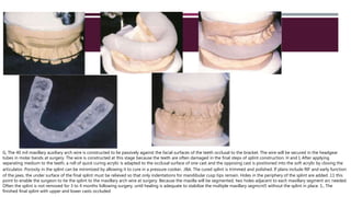 G, The 40 mil maxillary auxiliary arch wire is constructed to lie passively against the facial surfaces of the teeth occlusal to the bracket. The wire will be secured in the headgear
tubes in molar bands at surgery. The wire is constructed at this stage because the teeth are often damaged in the final steps of splint construction. H and I, After applying
separating medium to the teeth, a roll of quick curing acrylic is adapted to the occlusal surface of one cast and the opposing cast is positioned into the soft acrylic by closing the
articulator. Porosity in the splint can be minimized by allowing it to cure in a pressure cooker. J&k. The cured splint is trimmed and polished. If plans include RIF and early function
of the jaws, the under surface of the final splint must be relieved so that only indentations for mandibular cusp tips remain. Holes in the periphery of the splint are added .11 this
point to enable the surgeon to tie the splint to the maxillary arch wire at surgery. Because the maxilla will be segmented, two holes adjacent to each maxillary segment arc needed.
Often the splint is not removed for 3 to 4 months following surgery, until healing is adequate to stabilize the multiple maxillary segmcnt5 without the splint in place. 1., The
finished final splint with upper and lower casts occluded
 