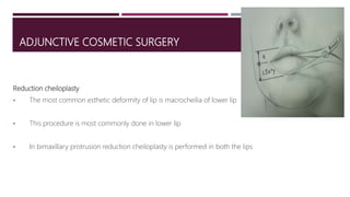 ADJUNCTIVE COSMETIC SURGERY
Reduction cheiloplasty
• The most common esthetic deformity of lip is macrocheilia of lower lip
• This procedure is most commonly done in lower lip
• In bimaxillary protrusion reduction cheiloplasty is performed in both the lips
 