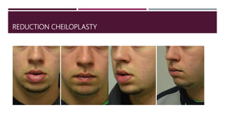 REDUCTION CHEILOPLASTY
 
