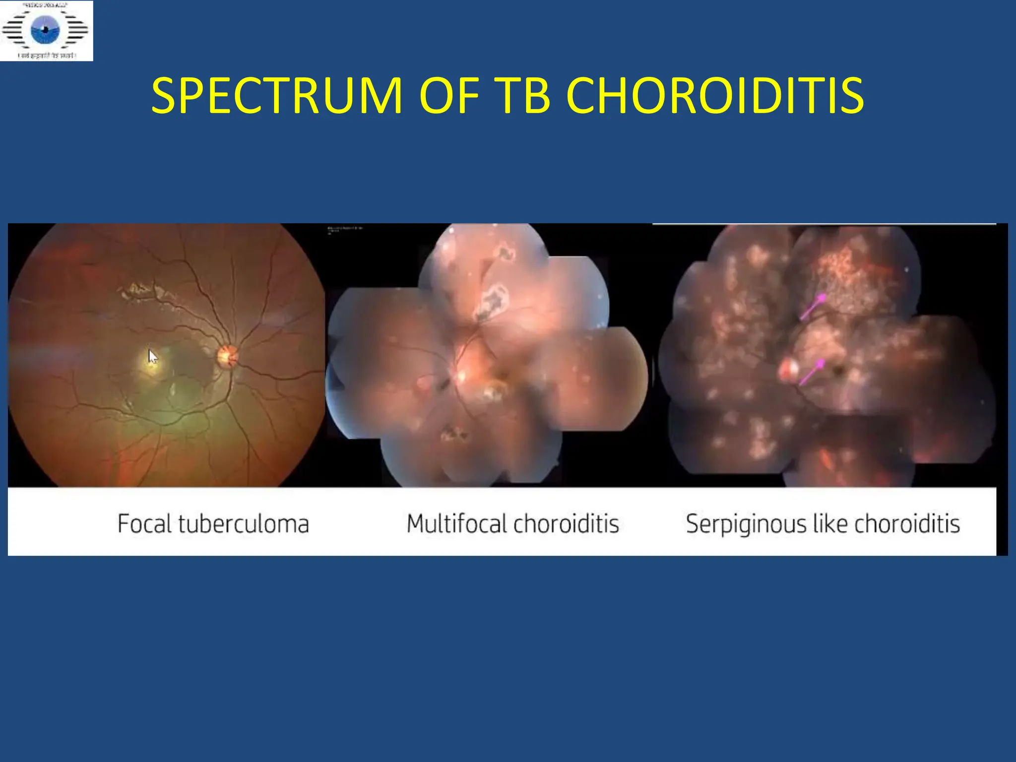 POST_UVEITIS_FINAL resentation dhir hospital bhiwani.pptx
