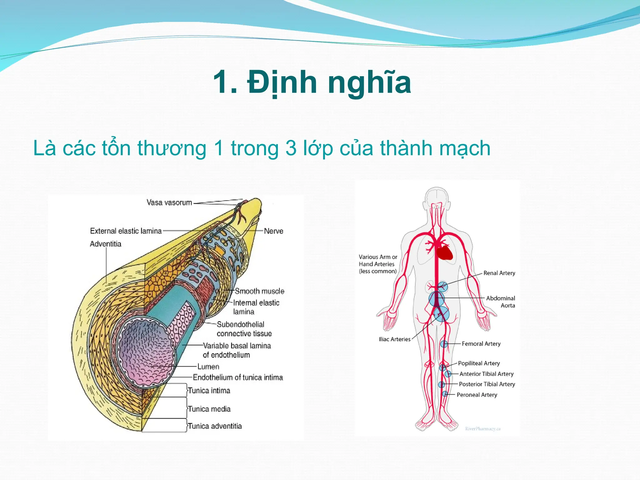 1. Định nghĩa
Là các tổn thương 1 trong 3 lớp của thành mạch
 