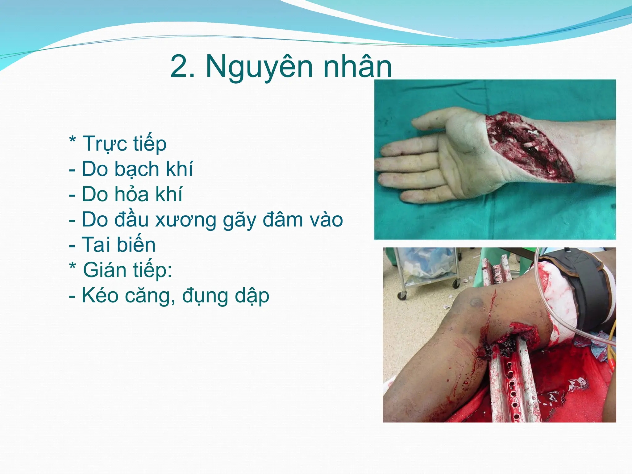 * Trực tiếp
- Do bạch khí
- Do hỏa khí
- Do đầu xương gãy đâm vào
- Tai biến
* Gián tiếp:
- Kéo căng, đụng dập
2. Nguyên nhân
 