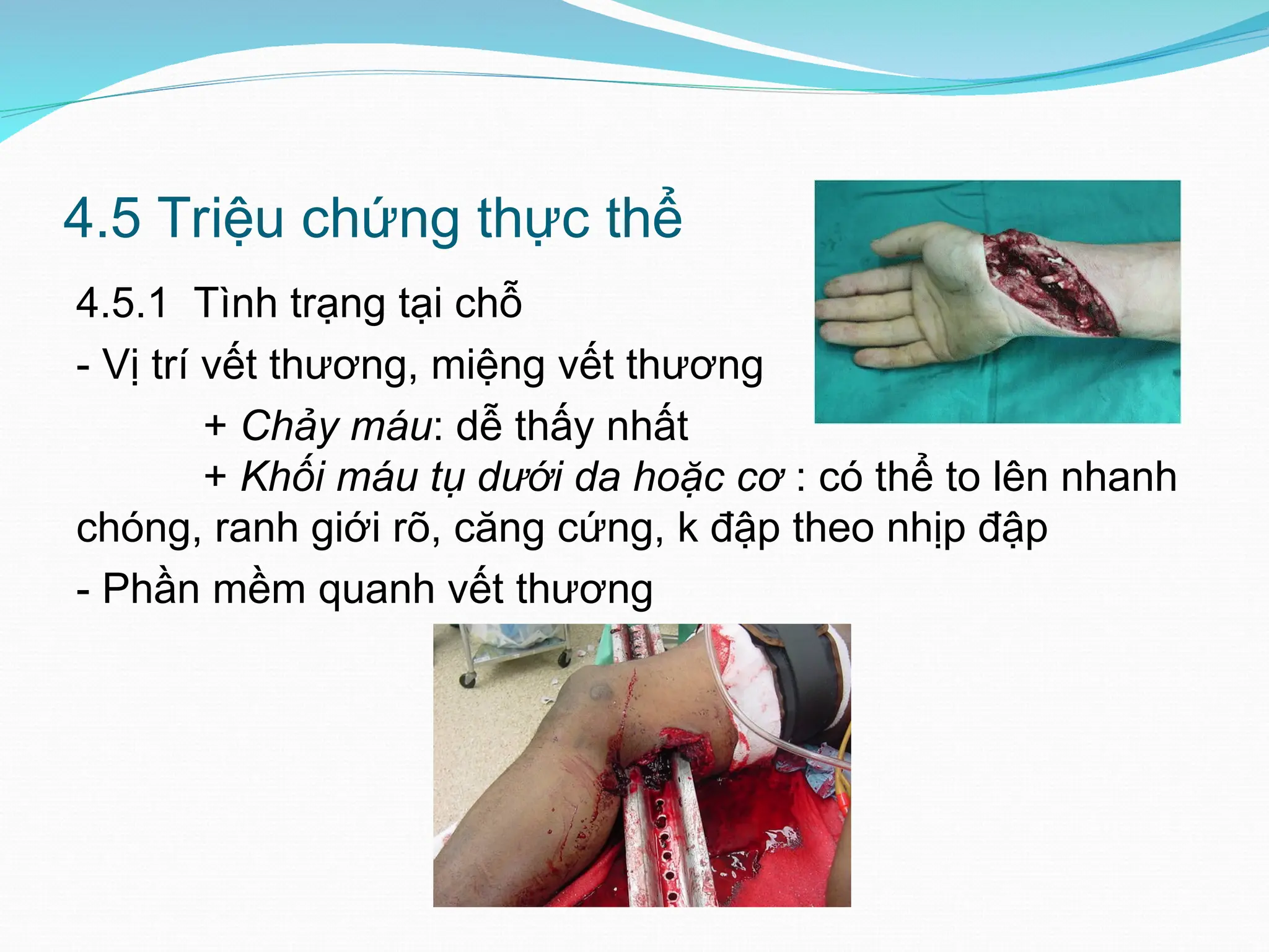4.5.1 Tình trạng tại chỗ
- Vị trí vết thương, miệng vết thương
+ Chảy máu: dễ thấy nhất
+ Khối máu tụ dưới da hoặc cơ : có thể to lên nhanh
chóng, ranh giới rõ, căng cứng, k đập theo nhịp đập
- Phần mềm quanh vết thương
4.5 Triệu chứng thực thể
 