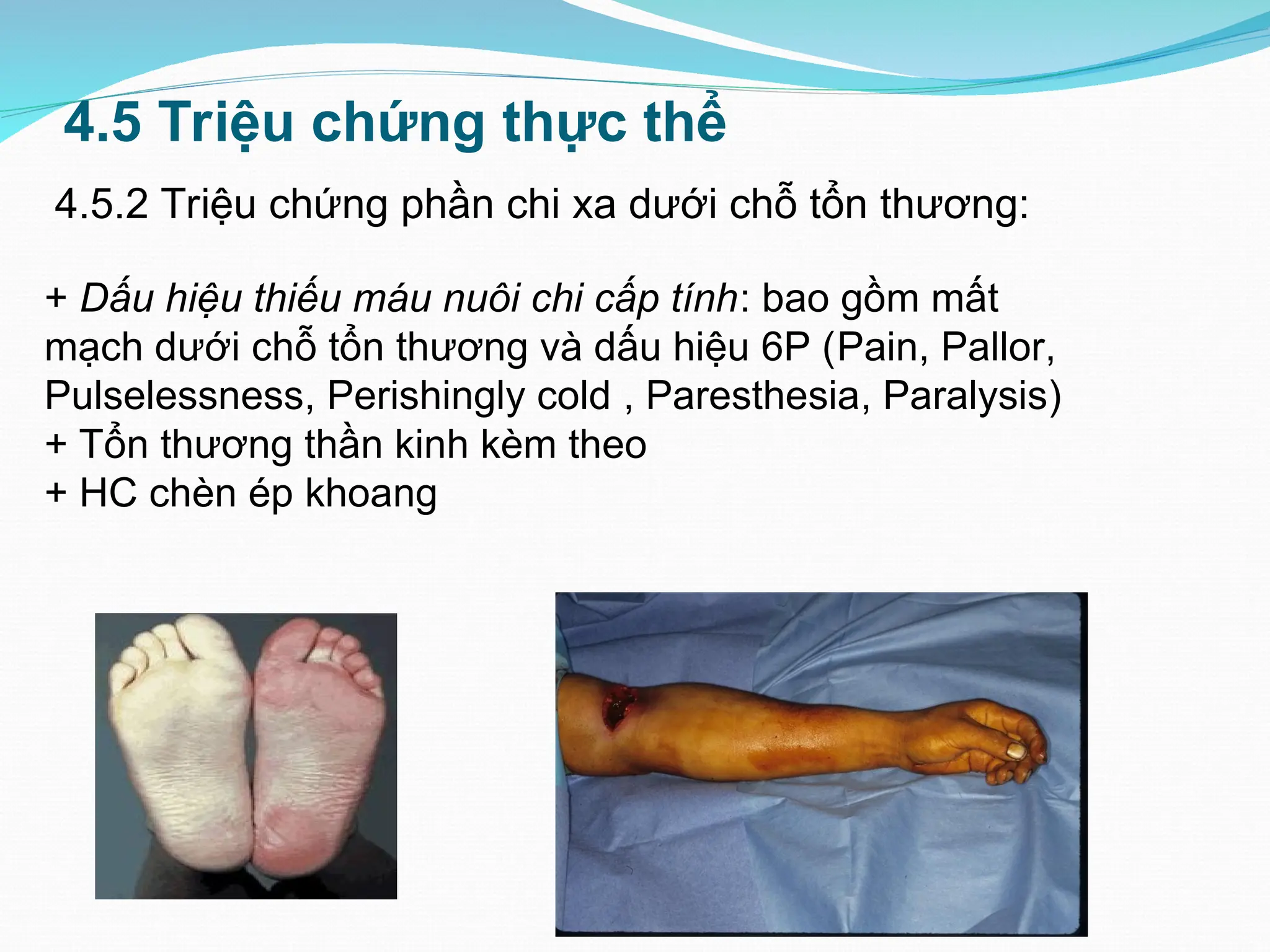 4.5 Triệu chứng thực thể
4.5.2 Triệu chứng phần chi xa dưới chỗ tổn thương:
+ Dấu hiệu thiếu máu nuôi chi cấp tính: bao gồm mất
mạch dưới chỗ tổn thương và dấu hiệu 6P (Pain, Pallor,
Pulselessness, Perishingly cold , Paresthesia, Paralysis)
+ Tổn thương thần kinh kèm theo
+ HC chèn ép khoang
 