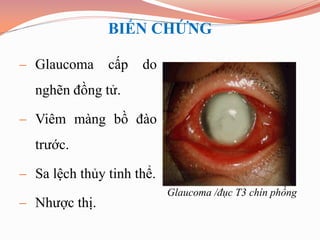  Glaucoma cấp do
nghẽn đồng tử.
 Viêm màng bồ đào
trước.
 Sa lệch thủy tinh thể.
 Nhược thị.
BIẾN CHỨNG
Glaucoma /đục ...