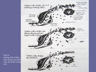 ANCA:
Kh¸ng thÓ chèng
bµo t¬ng cña b¹ch
cÇu ®a nh©n trung
tÝnh
 
