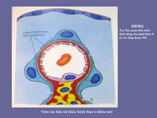 Viªm cÇu thËn tèi thiÓu (bÖnh thËn h nhiÔm mì)
MDHQ
Tuy liªn quan ®Õn miÔn
dÞch nhng cha ph¸t hiÖn ®-
îc c¸c l¾ng ®äng MD
 