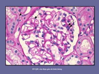 HVQH: cÇu thËn gÇn nh b×nh thêng
 