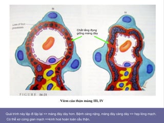 Viªm cÇu thËn mµng III, IV
Chất lắng đọng
giống màng đáy
Quá trình này lặp đi lặp lại => màng đáy dày hơn. Bệnh càng nặng, màng đáy càng dày => hẹp lòng mạch.
Có thể xơ cứng gian mạch =>kính hoá hoàn toàn cầu thận.
 