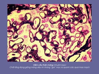 Viªm cÇu thËn mµng (nhuém b¹c)
ChÊt l¾ng ®äng gièng mµng d¸y nh nh÷ng “gai” mäc ra quanh c¸c quai mao m¹ch
 