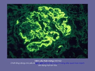 Viªm cÇu thËn mµng (MDHQ)
ChÊt l¾ng ®äng chñ yÕu lµ IgG, IgM vµ C3 tËp trung ë mµng ®¸y quai mao m¹ch
díi d¹ng h¹t lan táa.
 