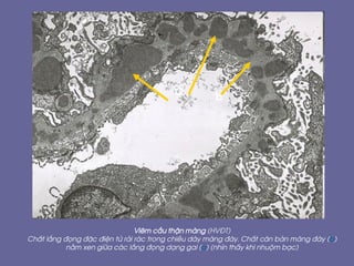 Viªm cÇu thËn mµng (HV§T)
ChÊt l¾ng ®äng ®Æc ®iÖn tö r¶i r¸c trong chiÒu dµy mµng ®¸y. ChÊt c¨n b¶n mµng ®¸y (b)
n»m xen gi÷a c¸c l¾ng ®äng d¹ng gai (a) (nh×n thÊy khi nhuém b¹c)
a
b
 