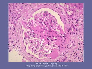 X¬ cÇu thËn æ – côc bé
(l¾ng ®äng chÊt kÝnh), g/® muén: x¬ hãa ®i kÌm
 