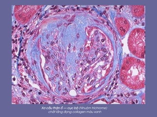 X¬ cÇu thËn æ – côc bé (Nhuém trichrome)
chÊt l¾ng ®äng collagen mµu xanh
 