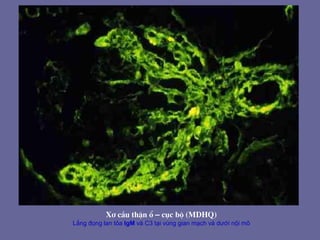 X¬ cÇu thËn æ – côc bé (MDHQ)
Lắng đọng lan tỏa IgM và C3 tại vùng gian mạch và dưới nội mô
 