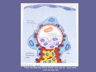 Viªm cÇu thËn sau nhiÔm khuÈn (t¨ng sinh néi – ngo¹i m¹ch)
(viªm cÇu thËn cÊp)
 