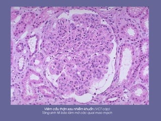 Viªm cÇu thËn sau nhiÔm khuÈn (VCT c¸p)
T¨ng sinh tÕ bµo lµm mê c¸c quai mao m¹ch
 