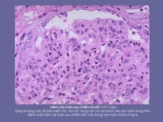 Viªm cÇu thËn sau nhiÔm khuÈn (VCT c¸p)
T¨ng sè lîng c¸c tÕ bµo biÓu m«, néi m«, trung m« vµ cµ b¹ch cÇu ®a nh©n trung tÝnh.
BÖnh xuÊt hiÖn vµi tuÇn sau nhiÔm liªn cÇu trïng tan m¸u nhãm A typ β.
 