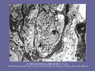 By Viªm cÇu thËn sau nhiÔm khuÈn (VCT c¸p)
ChÊt l¾ng ®äng miÔn dÞch chñ yÕu n»m díi biÓu m« tr«ng nh nh÷ng u (bíu) ®Æc ®iÖn tö
 