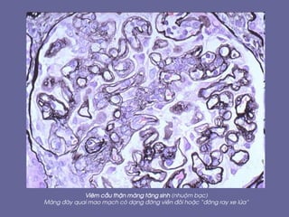 Viªm cÇu thËn mµng t¨ng sinh (nhuém b¹c)
Mµng ®¸y quai mao m¹ch cã d¹ng ®êng viÒn ®«i hoÆc “®êng ray xe löa”
 