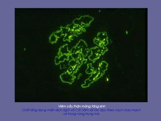 Viªm cÇu thËn mµng t¨ng sinh
ChÊt l¾ng ®äng miÔn dÞch (IgG vµ C3) n»m r¶i r¸c däc theo v¸ch mao m¹ch
vµ trong vïng trung m«.
 