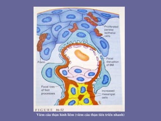 Viªm cÇu thËn h×nh liÒm (viªm cÇu thËn tiÕn triÓn nhanh)
 