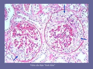Viêm cầu thận “hình liềm”
 