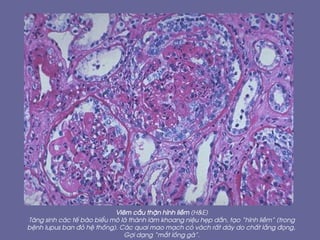 Viªm cÇu thËn h×nh liÒm (H&E)
T¨ng sinh c¸c tÕ bµo biÓu m« l¸ thµnh lµm khoang niÖu hÑp dÇn, t¹o “h×nh liÒm” (trong
bÖnh lupus ban ®á hÖ thèng). C¸c quai mao m¹ch cã v¸ch rÊt dµy do chÊt l¾ng ®äng,
Gîi d¹ng “m¾t lång gµ”.
 
