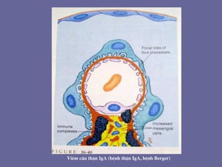 Viªm cÇu thËn IgA (bÖnh thËn IgA, bÖnh Berger)
 