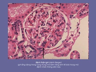 BÖnh thËn IgA (bÖnh Berger)
IgA l¾ng ®äng trong vïng trung m« kÌm t¨ng sinh tÕ bµo trung m«.
BÖnh nh©n thêng ®¸i m¸u
 
