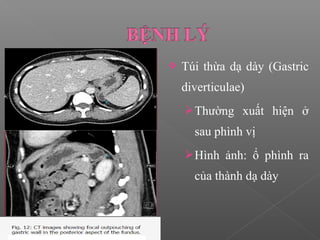  Túi thừa dạ dày (Gastric
diverticulae)
Thường xuất hiện ở
sau phình vị
Hình ảnh: ổ phình ra
của thành dạ dày
 