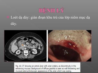  Loét dạ dày: gián đoạn khu trú của lớp niêm mạc dạ
dày.
 
