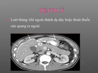  Loét thủng: khí ngoài thành dạ dày hoặc thoát thuốc
cản quang ra ngoài.
 