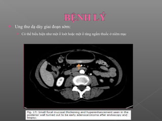  Ung thư dạ dày giai đoạn sớm:
 Có thể biểu hiện như một ổ loét hoặc một ổ tăng ngấm thuốc ở niêm mạc
 