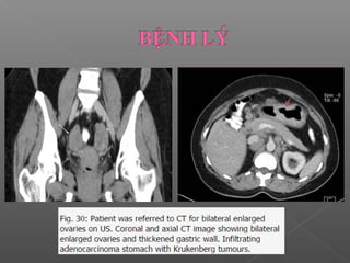 CLVT tiêu hóa: Dạ dày
