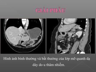 Hình ảnh bình thường và bất thường của lớp mỡ quanh dạ
dày do u thâm nhiễm.
 