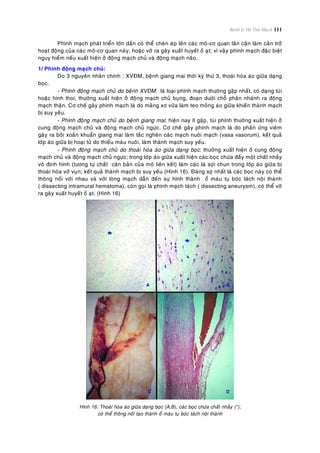 Bệnh lý Hệ Tim Mạch 111
Phình maïch phaùt trieån lôùn daàn coù theå cheøn eùp leân caùc moâ-cô quan laân caän laøm caûn trôû
hoaït ñoäng cuûa caùc moâ-cô quan naøy, hoaëc vôõ ra gaây xuaát huyeát oà aït; vì vaäy phình maïch ñaëc bieät
nguy hieåm neáu xuaát hieän ôû ñoäng maïch chuû vaø ñoäng maïch naõo.
1/ Phình ñoäng maïch chuû:
Do 3 nguyeân nhaân chính : XVÑM, beänh giang mai thôøi kyø thöù 3, thoaùi hoùa aùo giöõa daïng
boïc.
- Phình ñoäng maïch chuû do beänh XVÑM: laø loaïi phình maïch thöôøng gaëp nhaát, coù daïng tuùi
hoaëc hình thoi, thöôøng xuaát hieän ôû ñoäng maïch chuû buïng, ñoaïn döôùi choã phaân nhaùnh ra ñoäng
maïch thaän. Cô cheá gaây phình maïch laø do maûng xô vöõa laøm teo moûng aùo giöõa khieán thaønh maïch
bò suy yeáu.
- Phình ñoäng maïch chuû do beänh giang mai: hieän nay ít gaëp, tuùi phình thöôøng xuaát hieän ôû
cung ñoäng maïch chuû vaø ñoäng maïch chuû ngöïc. Cô cheá gaây phình maïch laø do phaûn öùng vieâm
gaây ra bôûi xoaén khuaån giang mai laøm taéc ngheõn caùc maïch nuoâi maïch (vasa vasorum), keát quaû
lôùp aùo giöõa bò hoaïi töû do thieáu maùu nuoâi, laøm thaønh maïch suy yeáu.
- Phình ñoäng maïch chuû do thoaùi hoùa aùo giöõa daïng boïc: thöôøng xuaát hieän ôû cung ñoäng
maïch chuû vaø ñoäng maïch chuû ngöïc; trong lôùp aùo giöõa xuaát hieän caùc boïc chöùa ñaày moät chaát nhaày
voâ ñònh hình (töông töï chaát caên baûn cuûa moâ lieân keát) laøm caùc laù sôïi chun trong lôùp aùo giöõa bò
thoaùi hoùa vôõ vuïn; keát quaû thaønh maïch bò suy yeáu (Hình 16). Ñaùng sôï nhaát laø caùc boïc naøy coù theå
thoâng noái vôùi nhau vaø vôùi loøng maïch daãn ñeán söï hình thaønh oå maùu tuï boùc taùch noäi thaønh
( dissecting intramural hematoma), coøn goïi laø phình maïch taùch ( dissecting aneurysm), coù theå vôõ
ra gaây xuaát huyeát oà aït. (Hình 16)
Hình 16: Thoaùi hoùa aùo giöõa daïng boïc (A,B), caùc boïc chöùa chaát nhaày (*);
coù theå thoâng noái taïo thaønh oå maùu tuï boùc taùch noäi thaønh
 