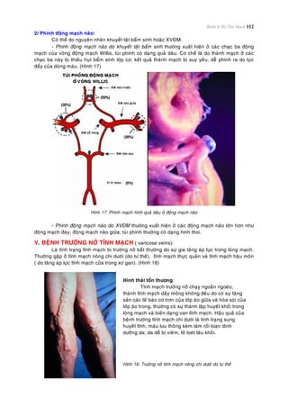 Bệnh lý Hệ Tim Mạch 112
2/ Phình ñoäng maïch naõo:
Coù theå do nguyeân nhaân khuyeát taät baåm sinh hoaëc XVÑM.
- Phình ñoäng maïch naõo do khuyeát taät baåm sinh thöôøng xuaát hieän ôû caùc chaïc ba ñoäng
maïch cuûa voøng ñoäng maïch Willis, tuùi phình coù daïng quaû daâu. Cô cheá laø do thaønh maïch ôû caùc
chaïc ba naøy bò thieáu huït baåm sinh lôùp cô; keát quaû thaønh maïch bò suy yeáu, deã phình ra do löïc
ñaåy cuûa doøng maùu. (Hình 17)
Hình 17: Phình maïch hình quaû daâu ôû ñoäng maïch naõo
- Phình ñoäng maïch naõo do XVÑM thöôøng xuaát hieän ôû caùc ñoäng maïch naõo lôùn hôn nhö
ñoäng maïch ñaùy, ñoäng maïch naõo giöõa; tuùi phình thöôøng coù daïng hình thoi.
V. BEÄNH TRÖÔÙNG NÔÛ TÓNH MAÏCH ( varicose veins):
Laø tình traïng tónh maïch bò tröôùng nôû baát thöôøng do söï gia taêng aùp löïc trong loøng maïch.
Thöôøng gaëp ôû tónh maïch noâng chi döôùi (do tö theá), tónh maïch thöïc quaûn vaø tónh maïch haäu moân
( do taêng aùp löïc tónh maïch cöûa trong xô gan). (Hình 18)
Hình thaùi toån thöông:
Tónh maïch tröôùng nôû chaïy ngoaèn ngoeøo,
thaønh tónh maïch daày moûng khoâng ñeàu do coù söï taêng
saûn caùc teá baøo cô trôn cuûa lôùp aùo giöõa vaø hoùa sôïi cuûa
lôùp aùo trong, thöôøng coù söï thaønh laäp huyeát khoái trong
loøng maïch vaø bieán daïng van tónh maïch. Haäu quaû cuûa
beänh tröôùng tónh maïch chi döôùi laø tình traïng sung
huyeát tónh, maùu löu thoâng keùm laøm roái loaïn dinh
döôõng da; da deã bò vieâm, lôû loeùt laâu khoûi.
Hình 18: Tröôùng nôû tónh maïch noâng chi döôùi do tö theá
 